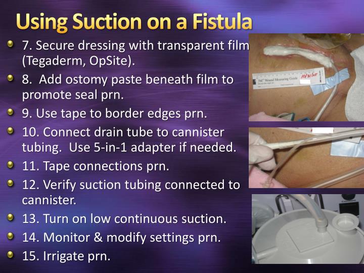 PPT Management of Enterocutaneous Fistulae PowerPoint Presentation