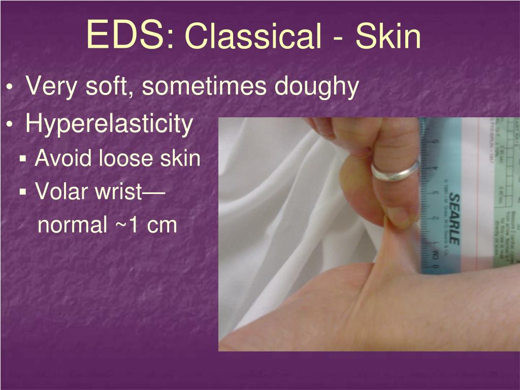 PPT Ehlers Danlos Syndrome Recognition, Diagnosis & Management PPT Ehlers Danlos Syndrome Recognition, Diagnosis & Management