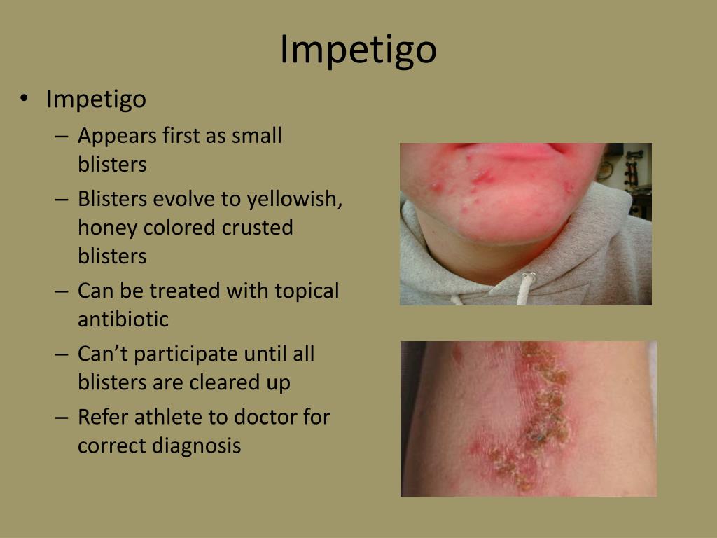 Ppt Skin Infections In Athletics Powerpoint Presentation Free
