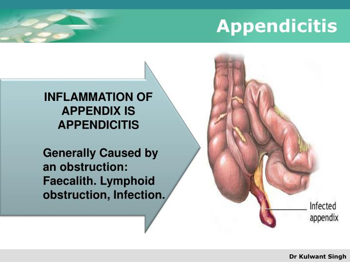 Ppt Appendicitis Powerpoint Presentation Id1703196