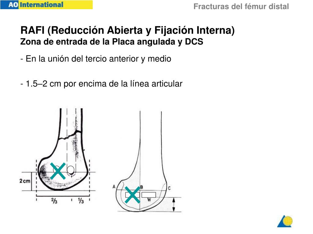 PPT - Fracturas Del F émur Distal PowerPoint Presentation, Free ...