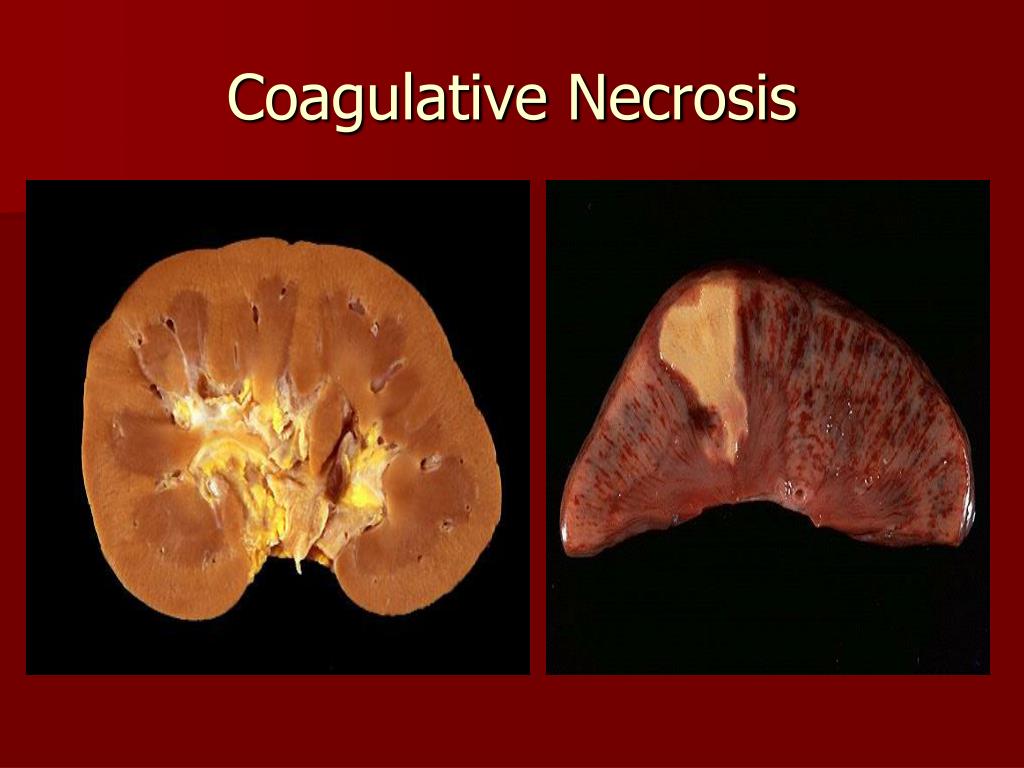 PPT Introduction To Basic Pathology Cellular Reaction To Injuries 