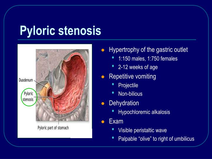 pyloric stenosis Read medical definition of pyloric stenosis pyloric stenosis: narrowing (stenosis) of the outlet of the stomach so that food cannot pass easily from it into the duodenum pyloric stenosis results in feeding problems and projectile vomiting in infa. pyloric stenosis Read medical definition of pyloric stenosis pyloric stenosis: narrowing (stenosis) of the outlet of the stomach so that food cannot pass easily from it into the duodenum pyloric stenosis results in feeding problems and projectile vomiting in infa.