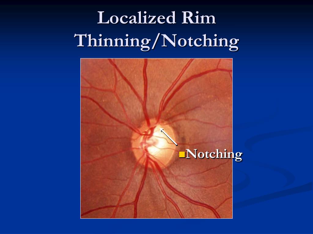 Ppt Fine Tuning Glaucoma Diagnosis And Management In Haiti Powerpoint Presentation Id1743379 