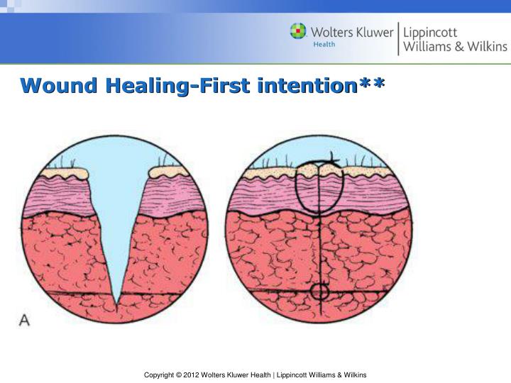 PPT Chapter 58 Special Skin and Wound Care PowerPoint Presentation