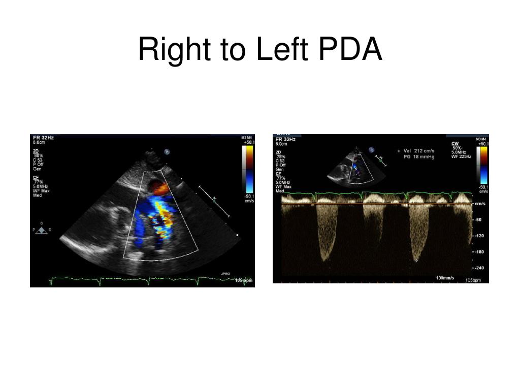 PPT - Pulmonary Hypertension: The Other High Blood Pressure PowerPoint ...