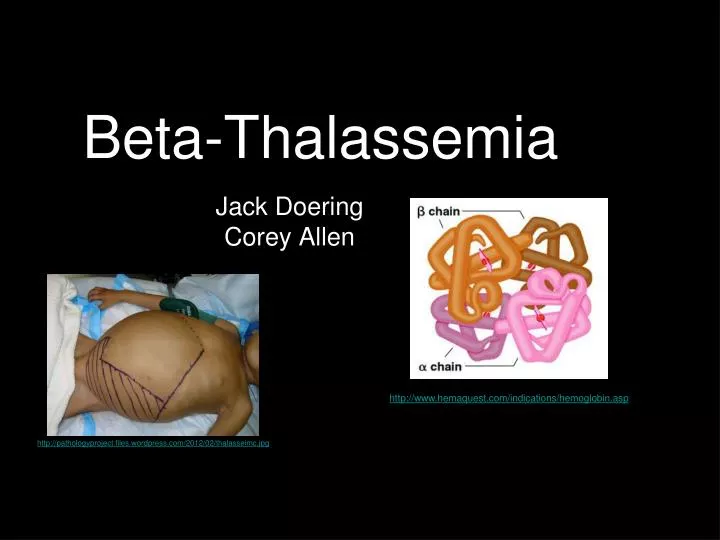 beta thalassemia n.