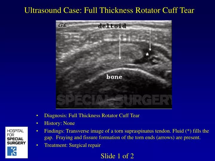 PPT - Ultrasound Case: Full Thickness Rotator Cuff Tear PowerPoint
