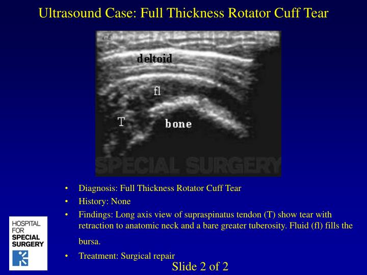 PPT Ultrasound Case Full Thickness Rotator Cuff Tear