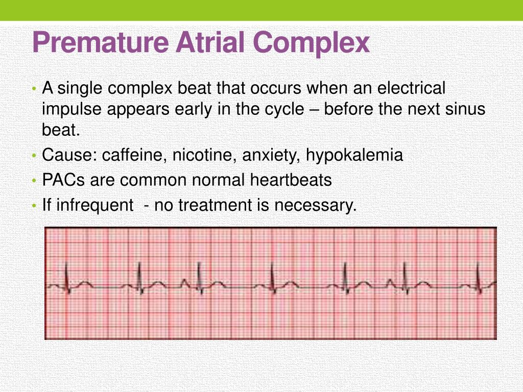 Premature Atrial Complexes