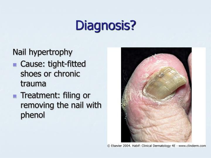 PPT - Onychomycosis PowerPoint Presentation - ID:1785081