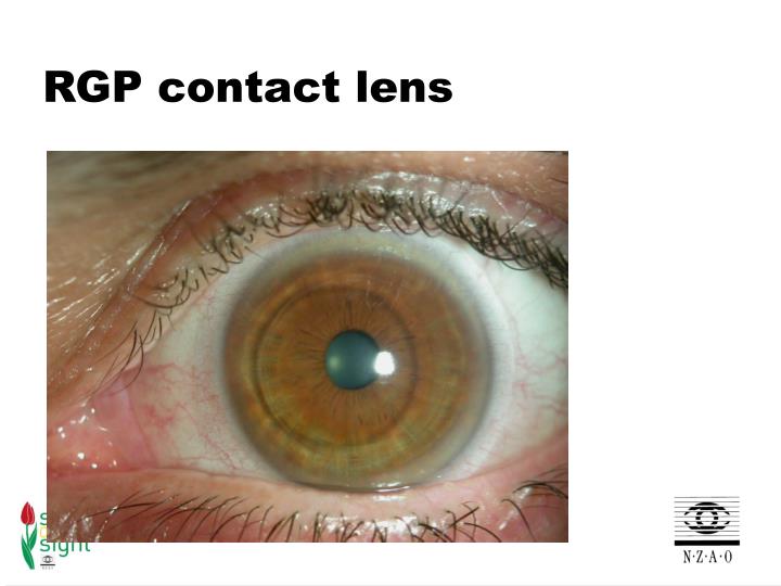 PPT Contact lenses PowerPoint Presentation ID1785702