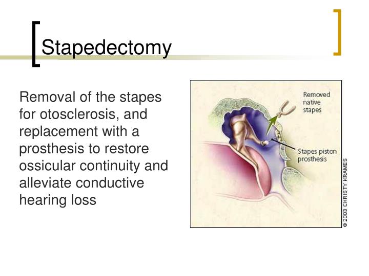 PPT ENT PowerPoint Presentation ID1785735