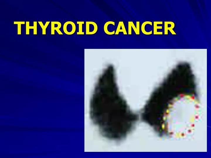 thyroid cancer n.