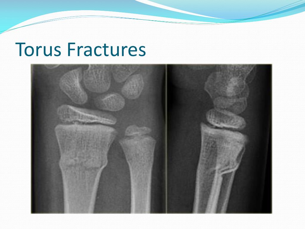 does a torus fracture need a cast