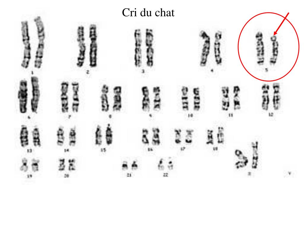 Изменения первой хромосомы. Кариотип Вольфа-Хиршхорна. Синдром Вольфа-Хиршхорна (делеция короткого плеча хромосомы 4). Синдром Вольфа-Хиршхорна кариотип. Синдром Хиршхорна кариотип.