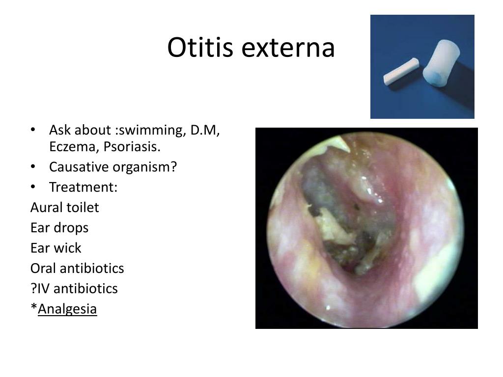 Otitis Externa Suomeksi Otitis Media FTWJBS