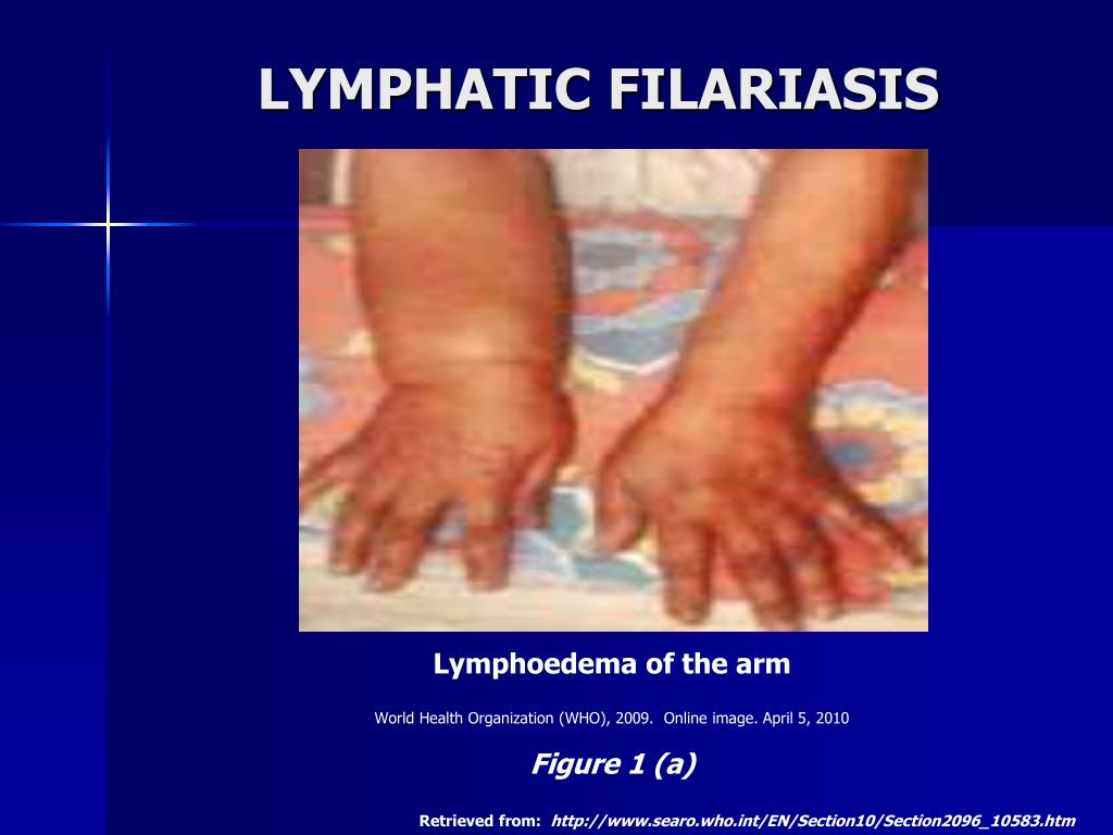 PPT - LYMPHATIC FILARIASIS A MAJOR PUBLIC HEALTH CHALLENGE IN THE 21ST ...