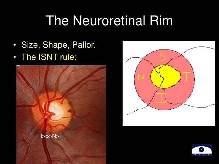 PPT Optic Disc Evaluation IN PowerPoint Presentation ID