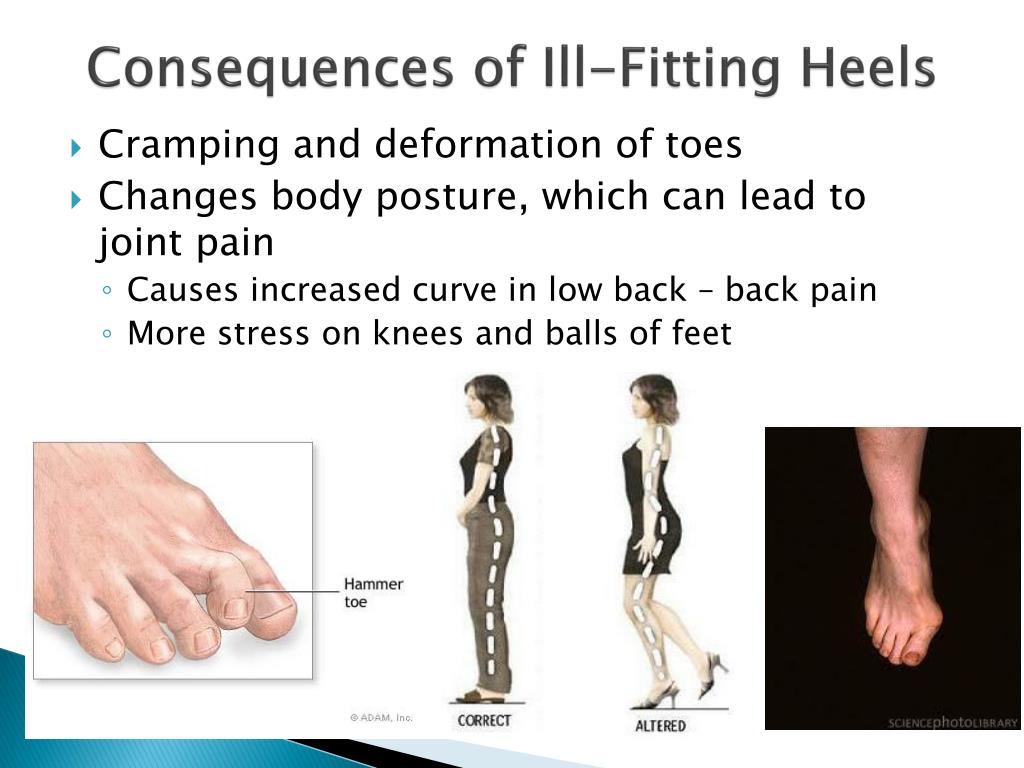 Improper Fitting PPT - Shoes and Foot Health for the Working Woman PowerPoint ...
