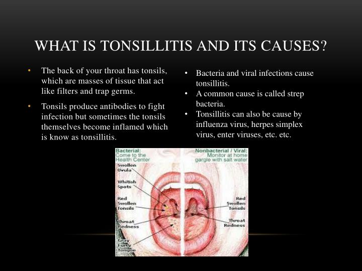 Ppt Tonsillitis And Appendicitis Powerpoint Presentation Id1843857