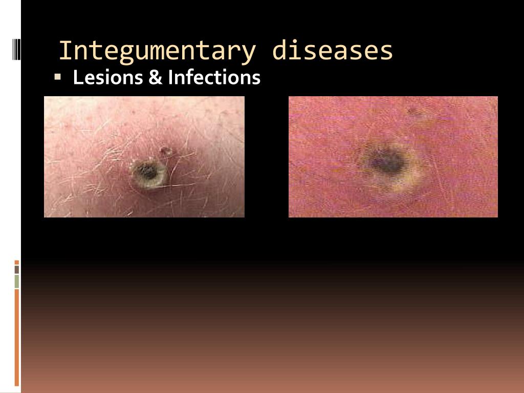 PPT - Selected Integumentary System Diseases & Conditions PowerPoint