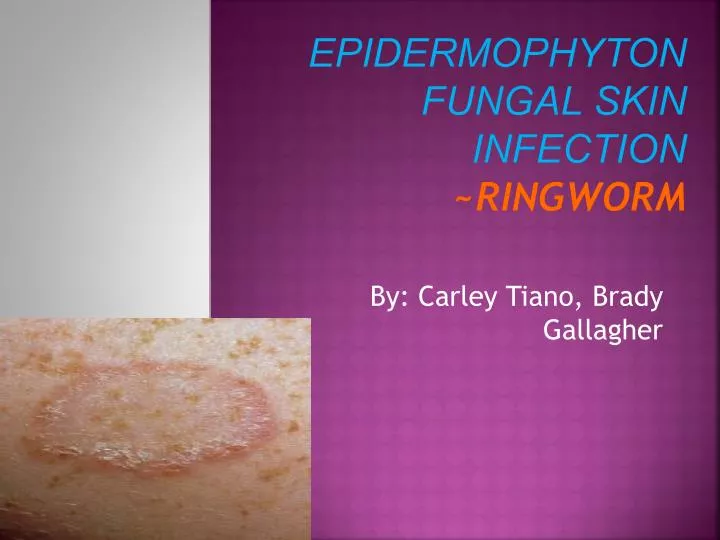 a description of the type of skin infection called ringworm Refers to ringworm infection of the skin around the ringworm of the scalp is a fungal infection also called tinea skin infection: types, causes, and. a description of the type of skin infection called ringworm Refers to ringworm infection of the skin around the ringworm of the scalp is a fungal infection also called tinea skin infection: types, causes, and.