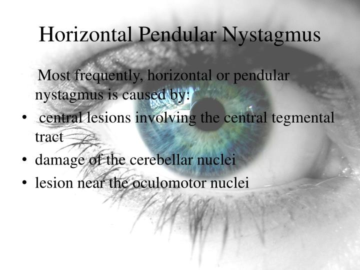 Ppt nystagmus powerpoint presentation id 1852222
