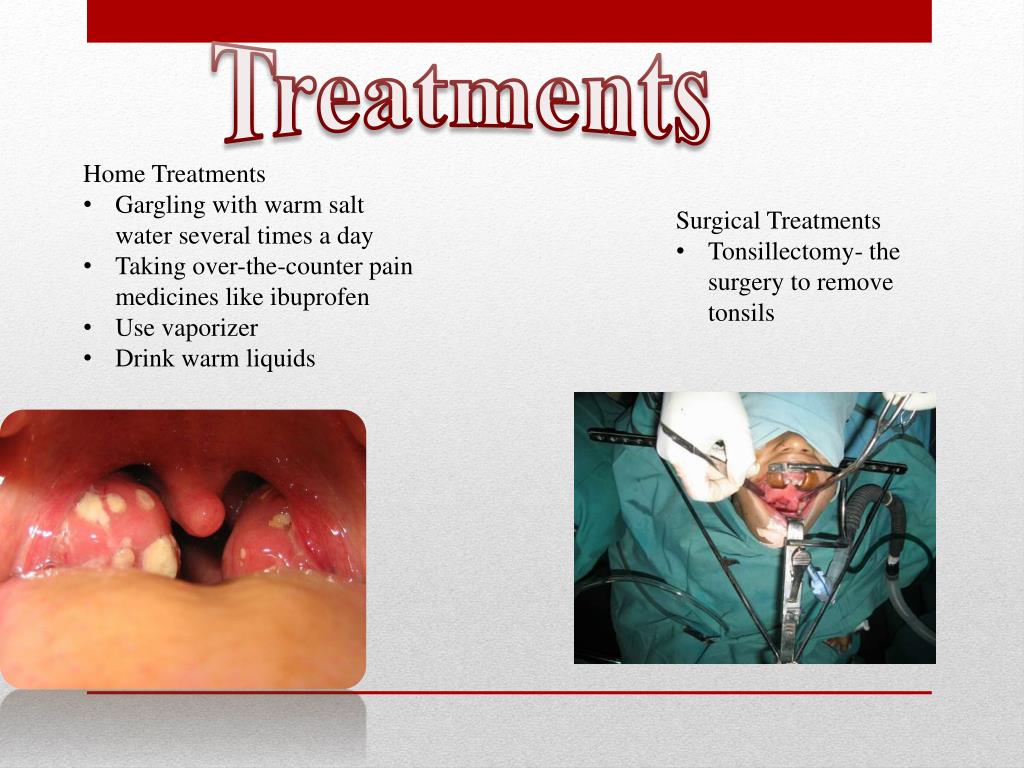 Ppt Tonsillitis Powerpoint Presentation Free Download Id1857321
