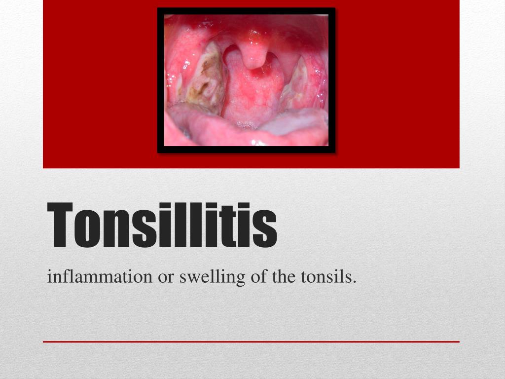 tonsillitis case presentation slideshare