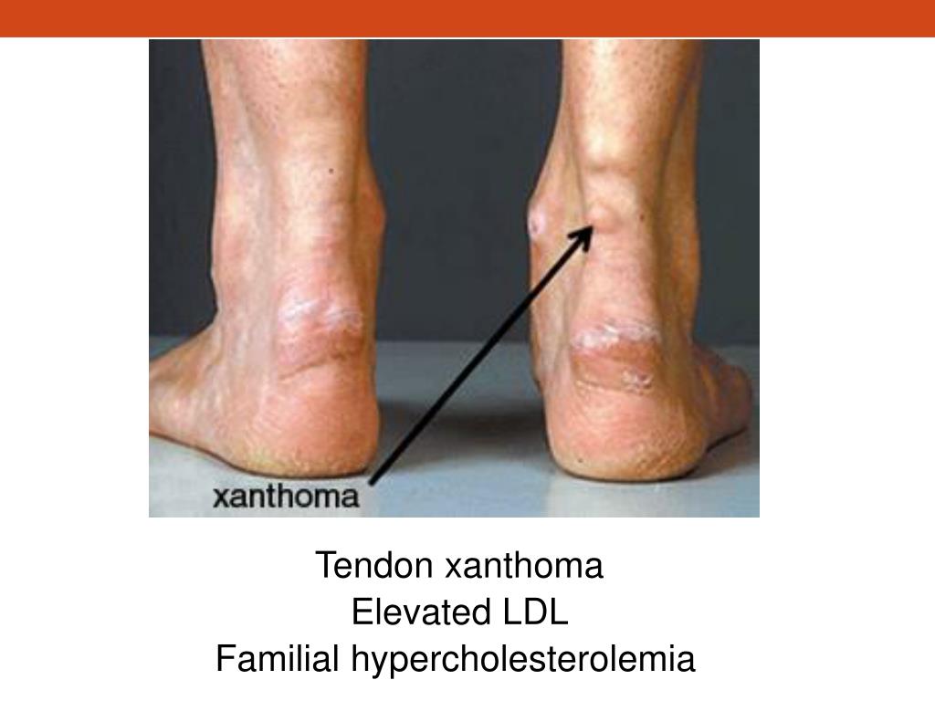 Tendon Xanthoma Hypercholesterolaemia Stock Photo Royalty Tendon Xanthoma Hypercholesterolaemia Stock Photo Royalty