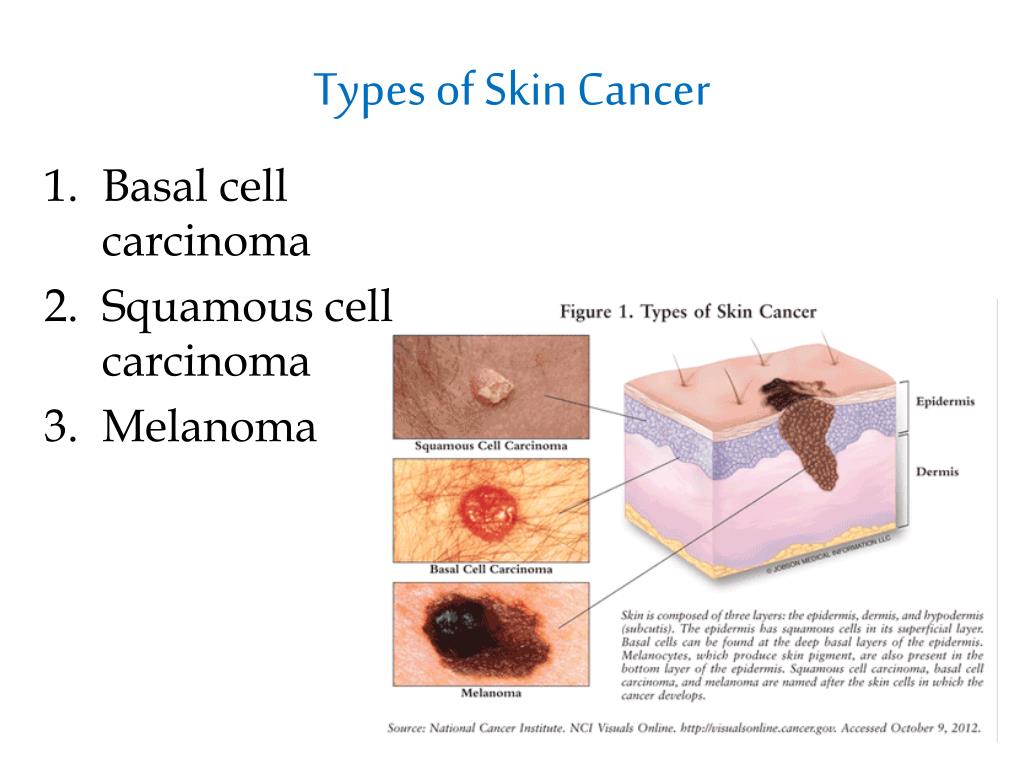 PPT - Skin Cancer PowerPoint Presentation, free download - ID:1861868