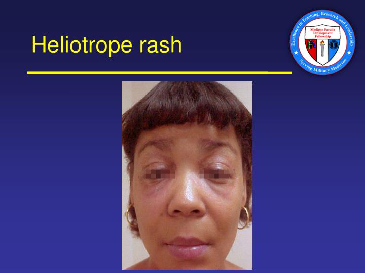 PPT - Is it Only Skin Deep? Dermatologic Evidence of Systemic Disease ...