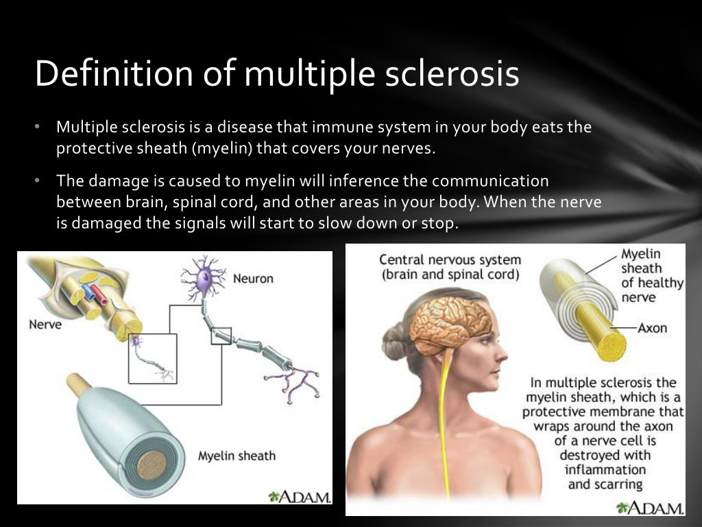 typical presentation of multiple sclerosis