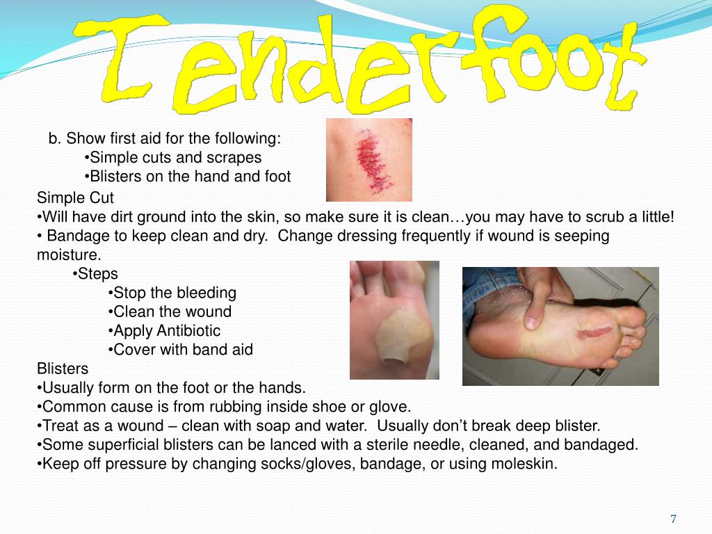 PPT Tenderfoot Requirement 12 a. Demonstrate how to care for someone