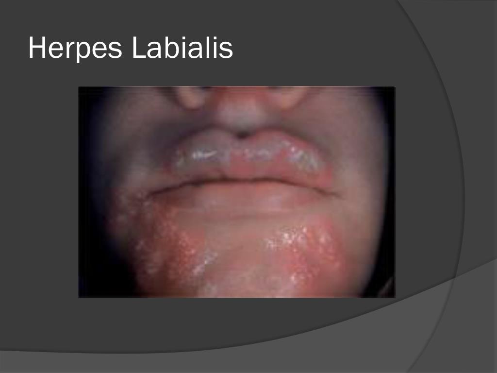 Acd Az Of Skin Herpes Labialis