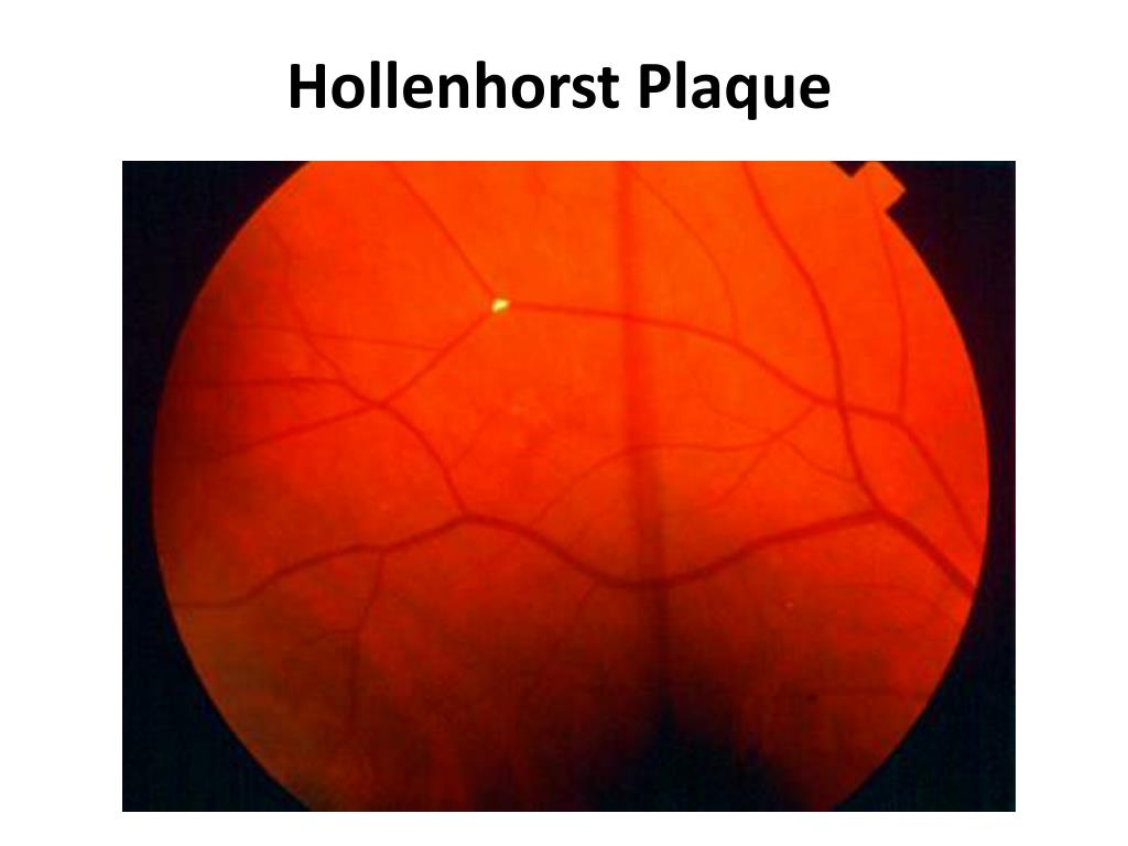PPT Stanford Medicine 25 Fundoscopy PowerPoint Presentation Free PPT Stanford Medicine 25 Fundoscopy PowerPoint Presentation Free