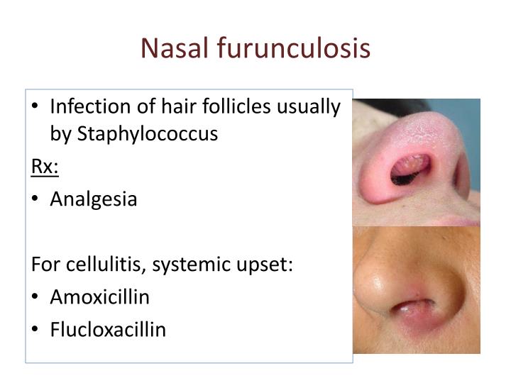 PPT - Nose, sinus, nasopharynx Dr K Outhoff PowerPoint Prese