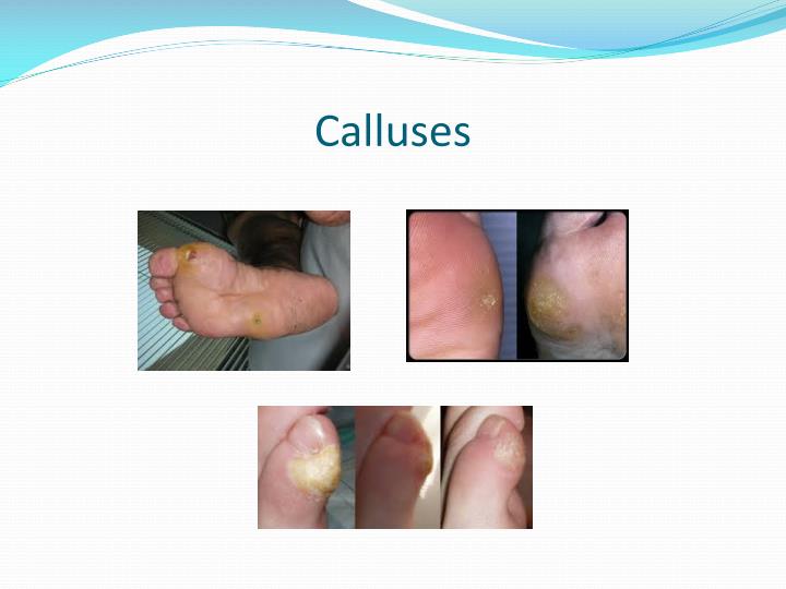 PPT - Assessing Charcot Foot in the Diabetic Patient with Peripheral ...