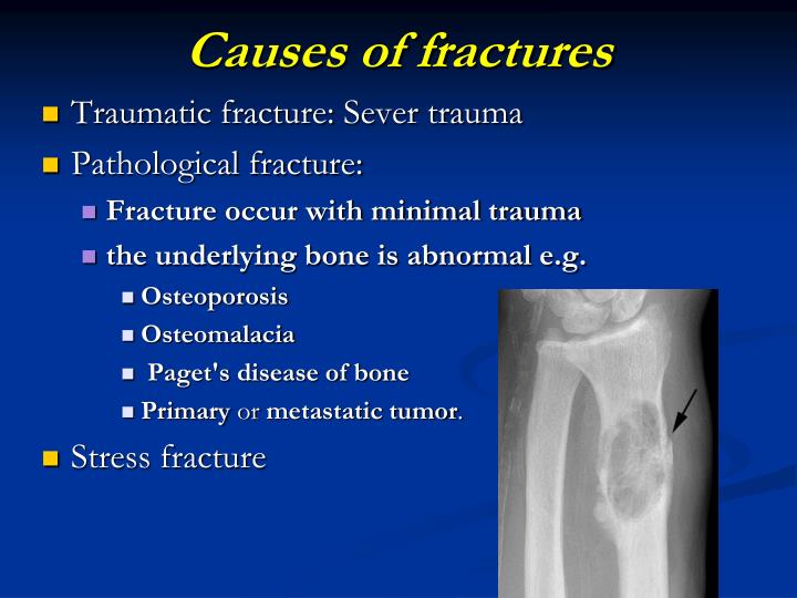 comminuted fracture causes comminuted fracture causes