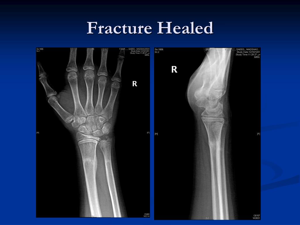 PPT - MUSCULOSKELETAL BLOCK Pathology Lecture 1: Fracture and bone