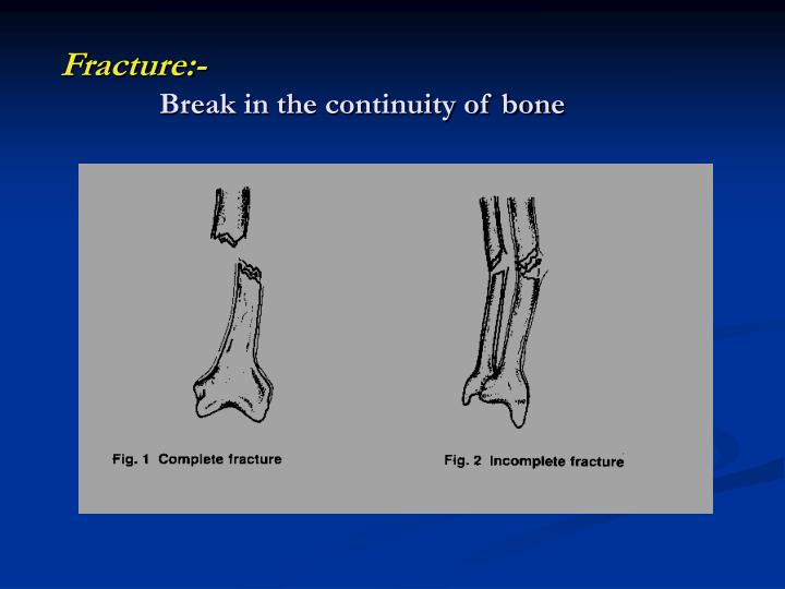 bone fracture vs break
