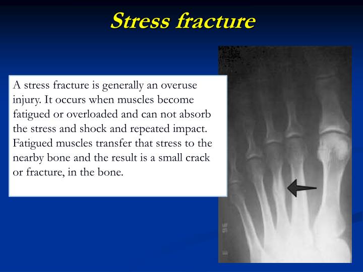 PPT - MUSCULOSKELETAL BLOCK Pathology Lecture 1: Fracture And Bone ...