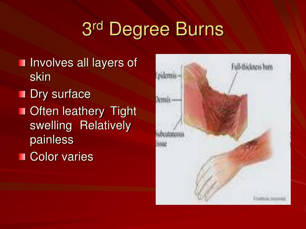 Topical Treatment For Third Degree Burns At Gabriel Chubb Blog Topical Treatment For Third Degree Burns At Gabriel Chubb Blog