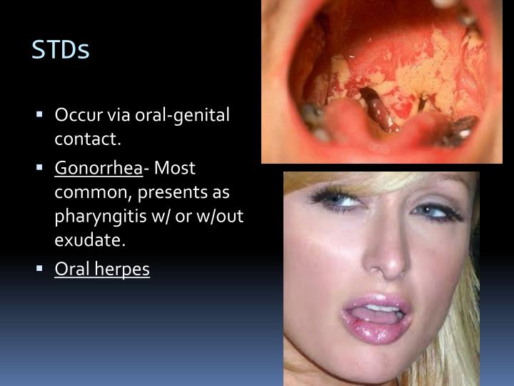 gonorrhea symptoms female mouth