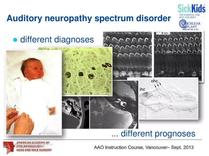 auditory neuropathy spectrum disorder recommendaions auditory neuropathy spectrum disorder recommendaions