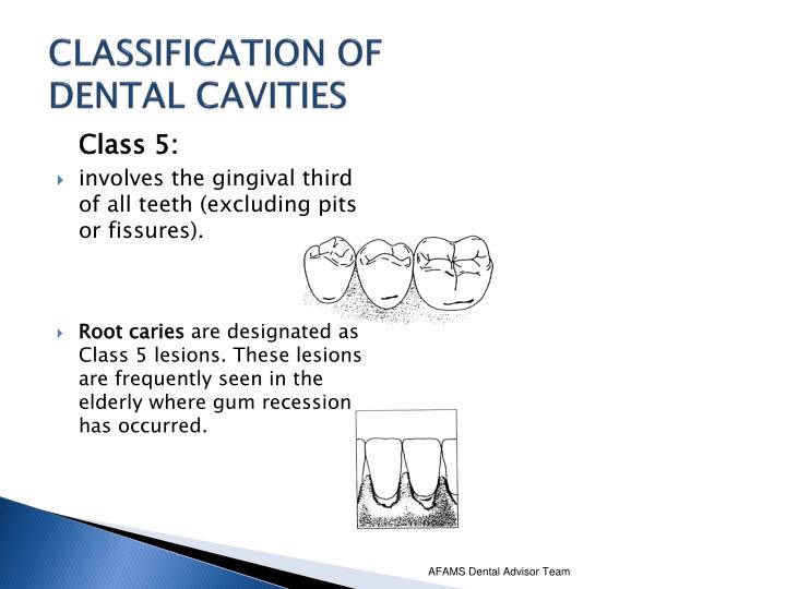 dental calculus classification dental calculus classification