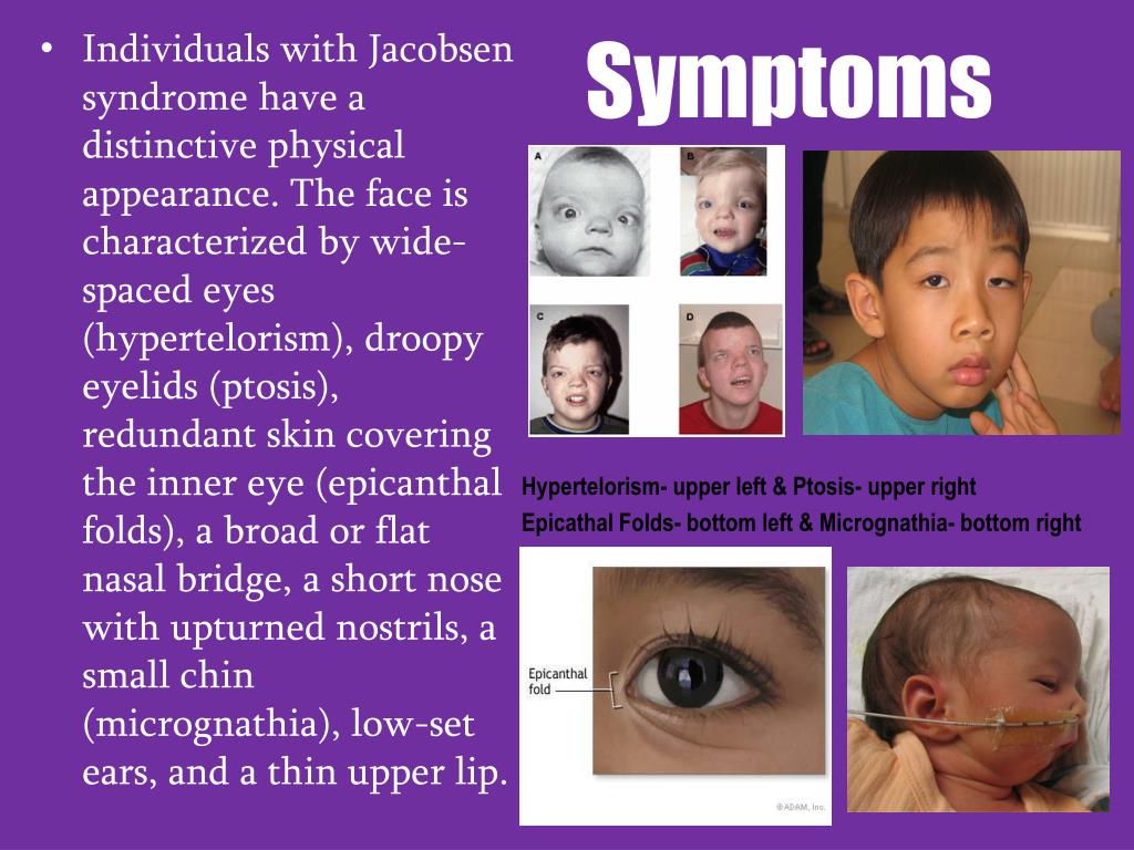 Jacobsen Syndrome PPT Jacobsen Syndrome PowerPoint Presentation, free Jacobsen Syndrome PPT Jacobsen Syndrome PowerPoint Presentation, free