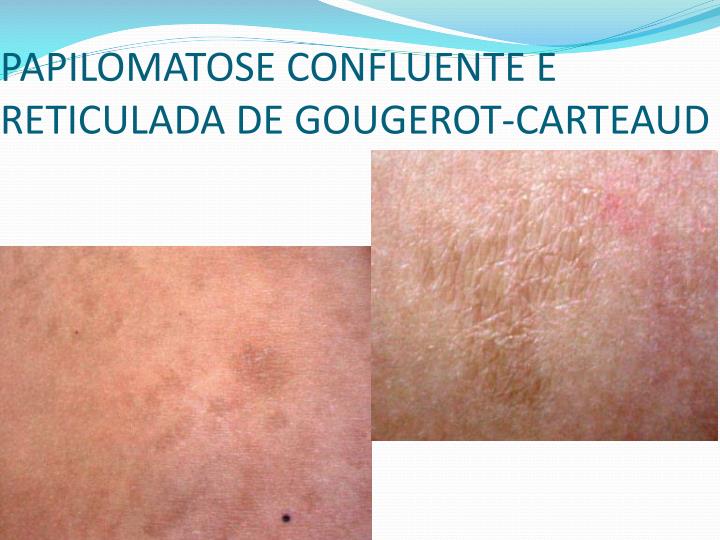 PPT - DERMATOSES QUERATÓTICAS PowerPoint Presentation - ID PPT - DERMATOSES QUERATÓTICAS PowerPoint Presentation - ID