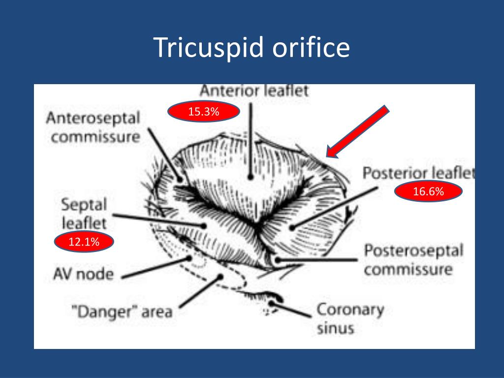 PPT Tricuspid Valve Disease PowerPoint Presentation, free download